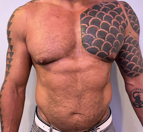 Gynecomastia