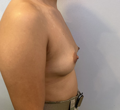 Breast Augmentation