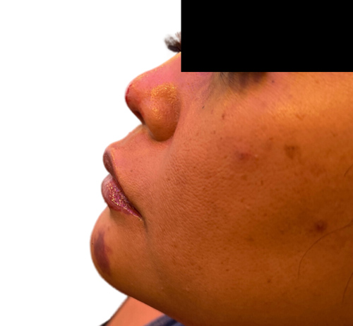 Patient after Non-Surgical Rhinoplasty