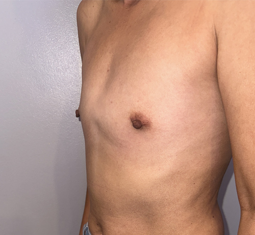 Breast Augmentation