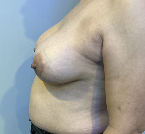 Breast Augmentation